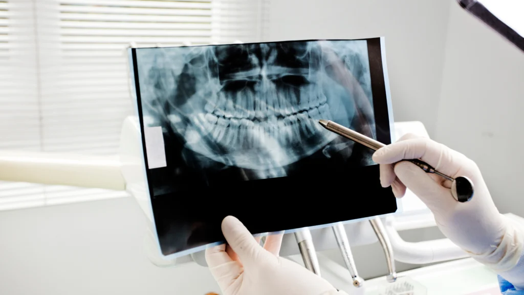 izmit-cene-cerrahi - Marjinal Dent - İzmit ve Kocaeli Diş Kliniği Dentist Wearing Gloves Holds a Dental X-ray Film with a Pen Resting on the Image, Showing Upper and Lower Teeth. - Marjinal Dent - İzmit Ve Kocaeli Diş Kliniği