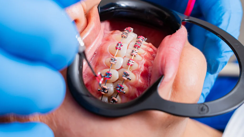 Close-up of a Patient’s Mouth with Braces and Colorful Elastics During a Dental Procedure, Blue Gloves Visible. - Marjinal Dent - İzmit Ve Kocaeli Diş Kliniği