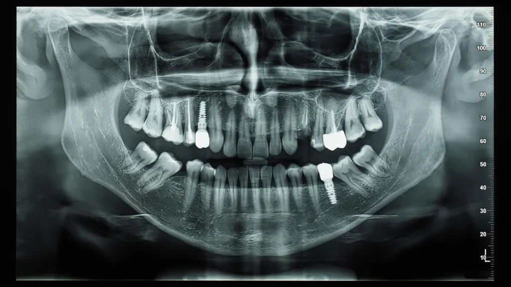 kocaeli-implant - Marjinal Dent - İzmit ve Kocaeli Diş Kliniği - Marjinal Dent - İzmit Ve Kocaeli Diş Kliniği
