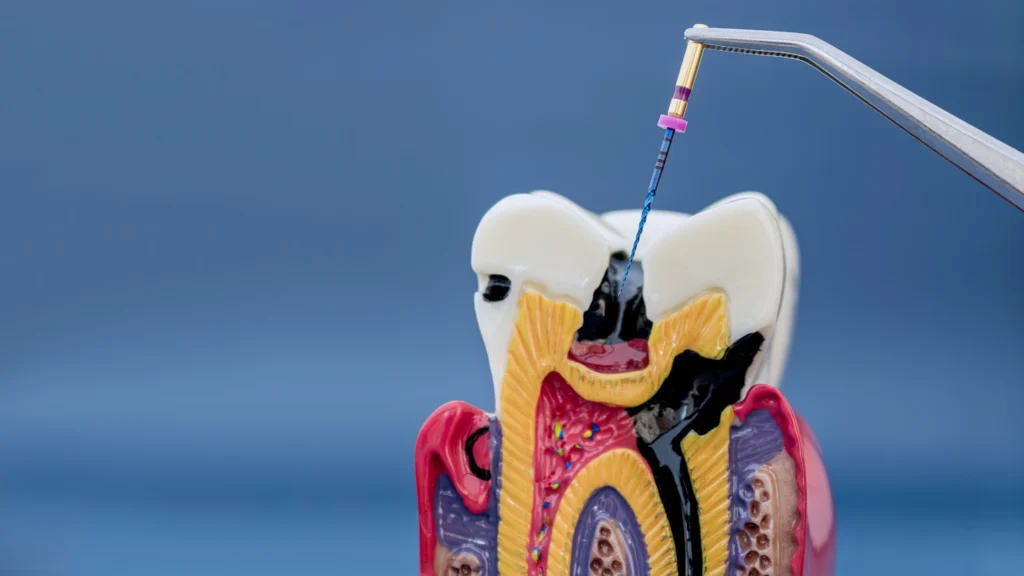 Close-up of a Colorful Ceramic Dental Model with a Small Device Positioned Near the Teeth Against a Blue Background. - Marjinal Dent - İzmit Ve Kocaeli Diş Kliniği