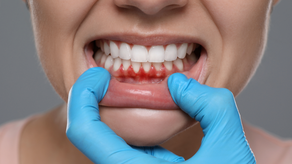 dis-eti-cekilmesi-nedenleri - Marjinal Dent - İzmit ve Kocaeli Diş Kliniği Dis-eti-cekilmesi-nedenleri - Marjinal Dent - İzmit Ve Kocaeli Diş Kliniği