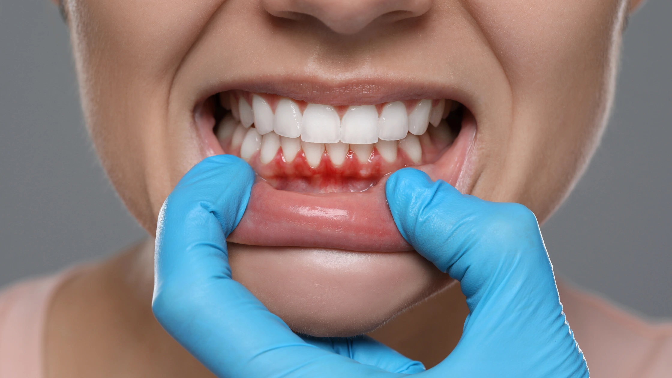 Close-up of a Patient's Mouth with Inflamed Red Lower Gums Being Examined by a Dentist Wearing Blue Gloves. - Marjinal Dent - İzmit Ve Kocaeli Diş Kliniği